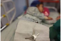 خروج موفقیت‌آمیز دسته کلید از معده کودک در سبزوار با روش آندوسکوپی